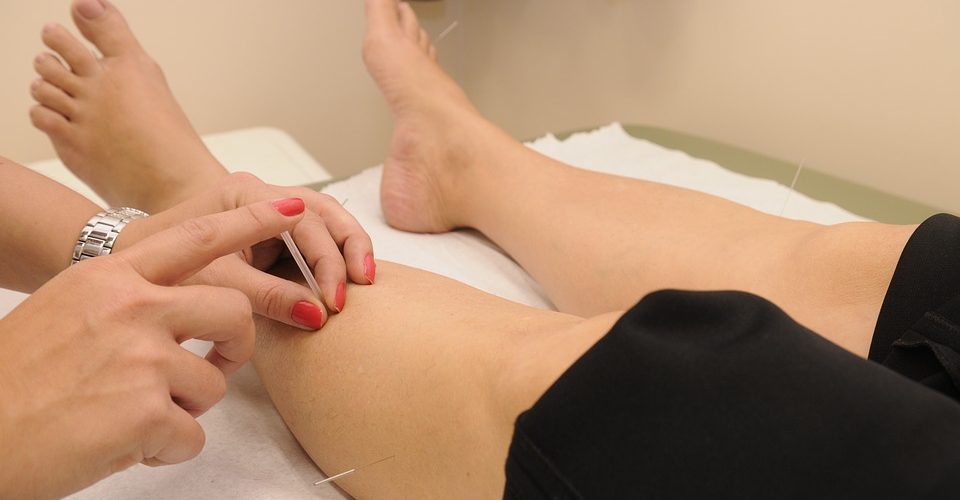 acupuncture